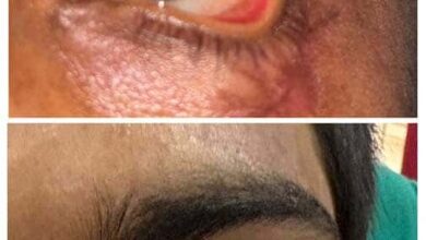 मेडिकल चमत्कार! स्किन ग्राफ्टिंग से दोबारा बनी मरीज की पलक