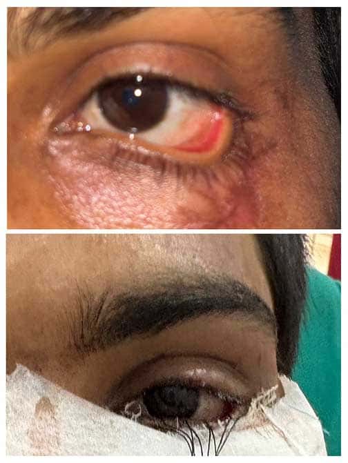 मेडिकल चमत्कार! स्किन ग्राफ्टिंग से दोबारा बनी मरीज की पलक