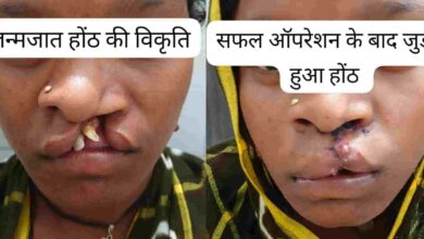 सफलता की कहानी: जन्मजात होंठ की विकृति का हुआ सफल उपचार, अब सामान्य जीवन जी रही हैं 22 वर्षीय युवती सफलता की कहानी: जन्मजात होंठ की विकृति का हुआ सफल उपचार, अब सामान्य जीवन जी रही हैं 22 वर्षीय युवती