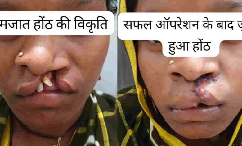 सफलता की कहानी: जन्मजात होंठ की विकृति का हुआ सफल उपचार, अब सामान्य जीवन जी रही हैं 22 वर्षीय युवती