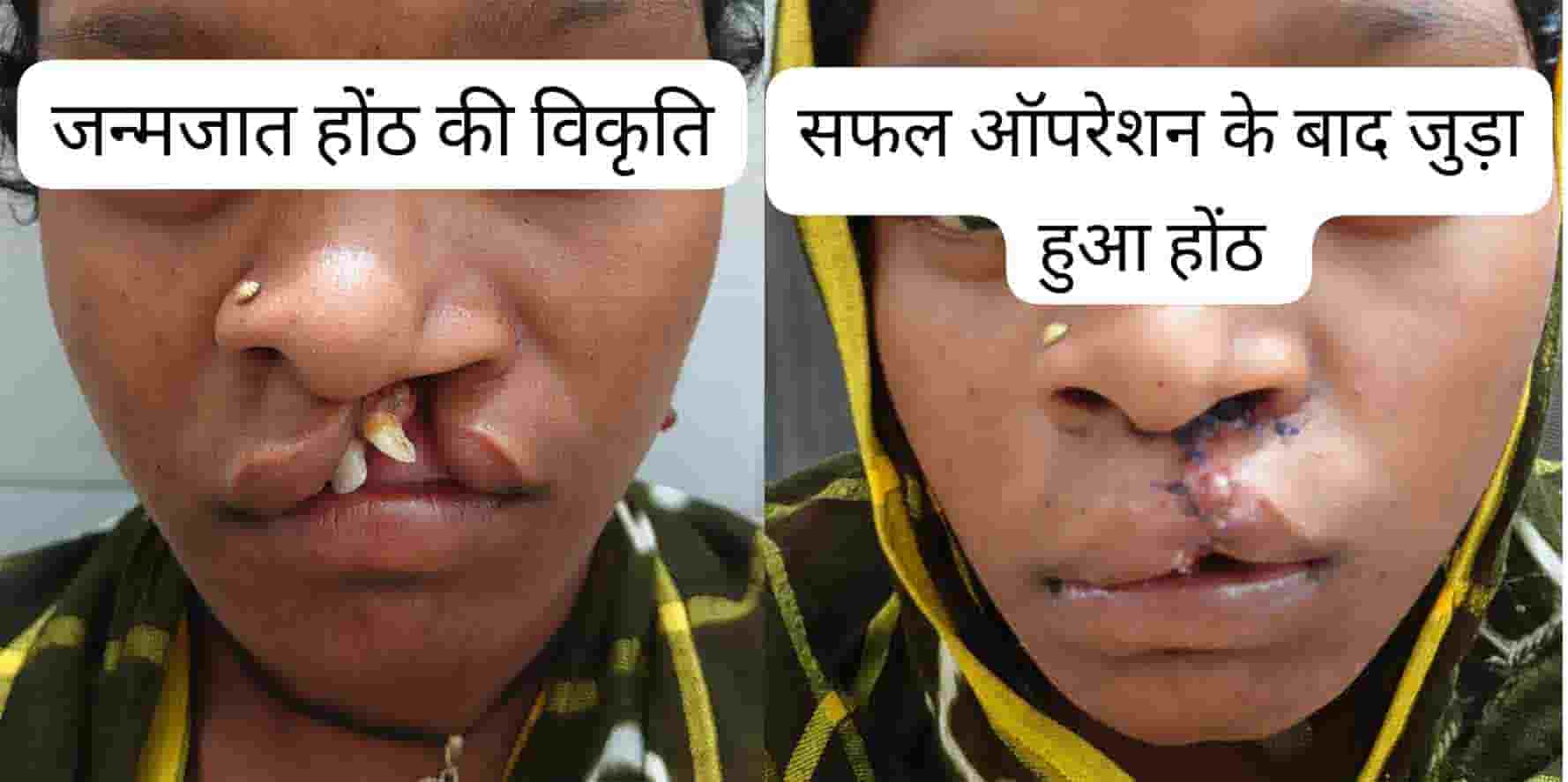 सफलता की कहानी: जन्मजात होंठ की विकृति का हुआ सफल उपचार, अब सामान्य जीवन जी रही हैं 22 वर्षीय युवती