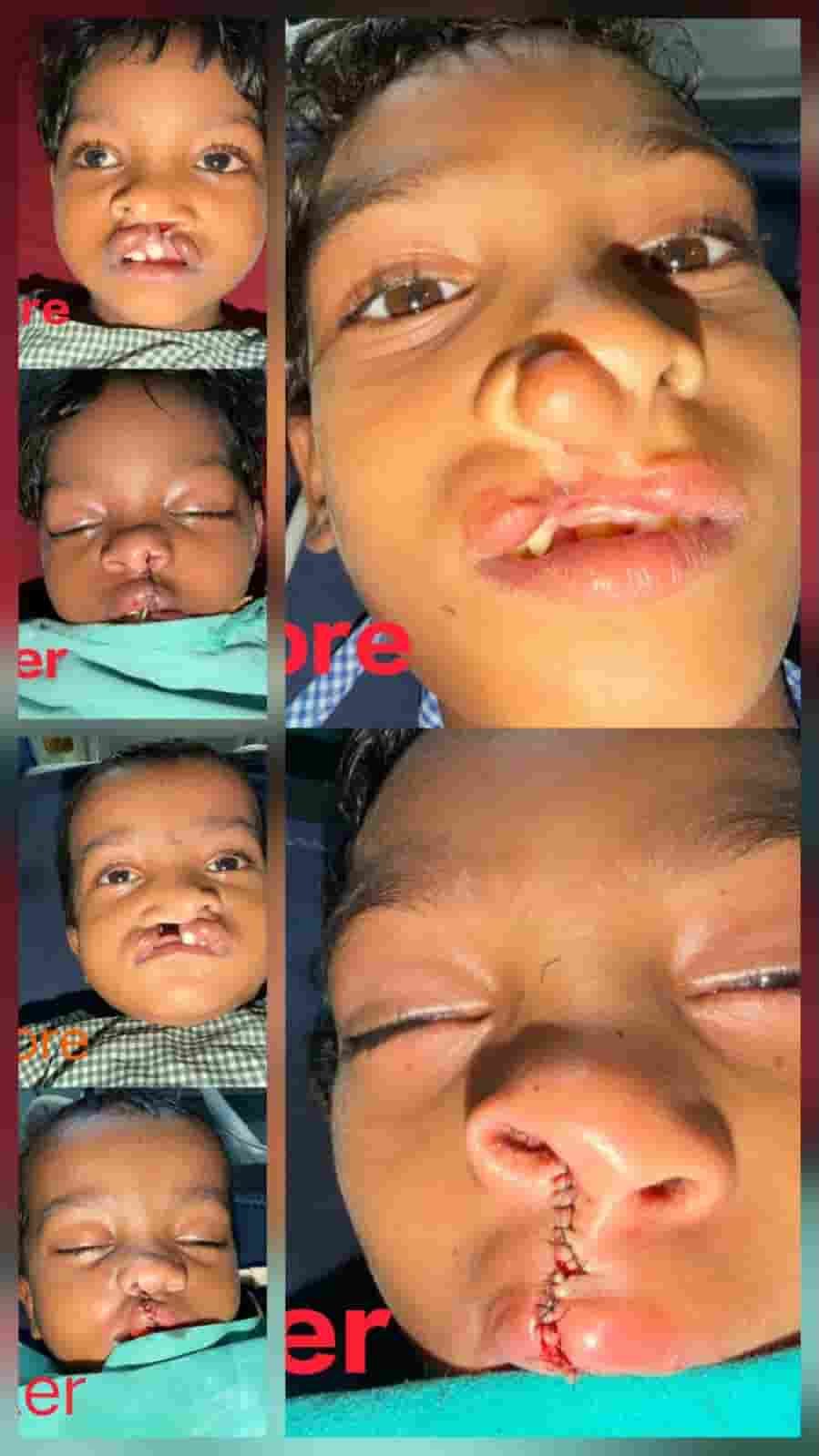 इलाज से खिली मुस्कान, चिरायु योजना ने तीन बच्चों को दी नई उम्मीद इलाज से खिली मुस्कान, चिरायु योजना ने तीन बच्चों को दी नई उम्मीद